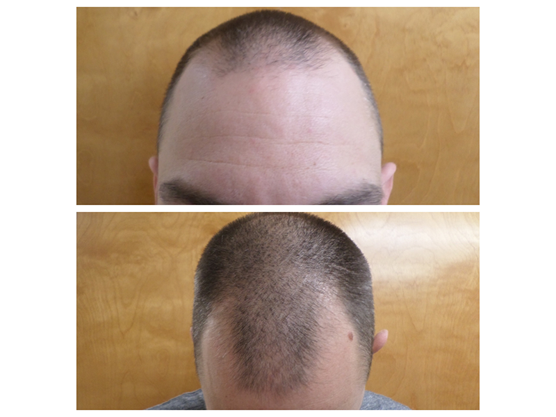 Hair Transplantation in New York: What You Need to Know post thumbnail image