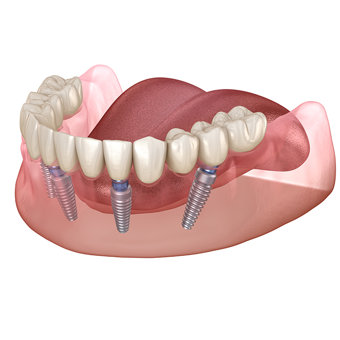 All-on-4: Experience Immediate Fixed Teeth After Treatment post thumbnail image