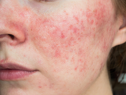 Learn About the Different Types of Acne Treatment Options post thumbnail image