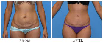 Get Ready for Swimsuit Season with a Tummy Tuck Procedure in Miami post thumbnail image