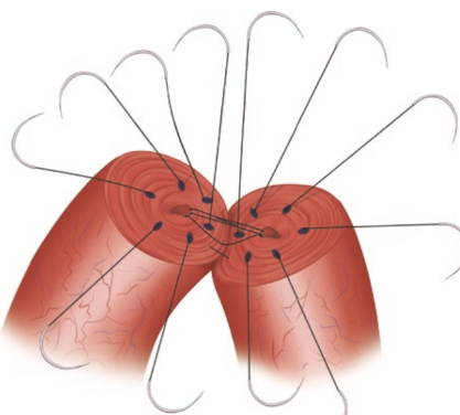 Vasectomy Reversal Success Rates: The Facts You Should Consider post thumbnail image