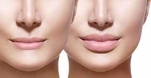 Kissable Lip area Wait for: Exploring the ideal Lip Fillers in Santa Barbara post thumbnail image